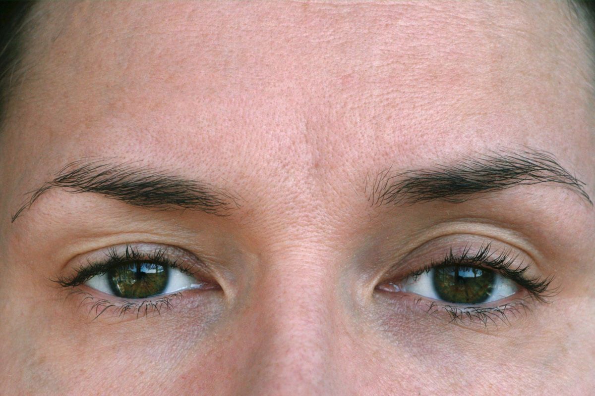 Why Are My Eyelids Droopy After Botox