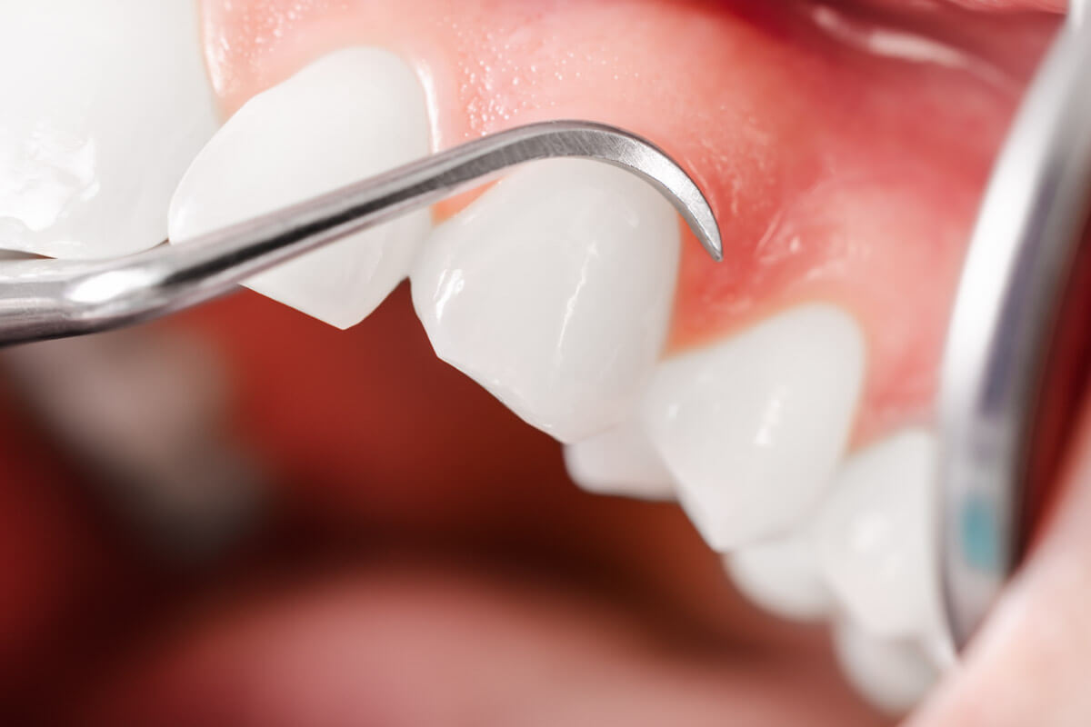 Zahnfleisch Und Mundschleimhautbeschwerden