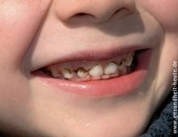 Zahnbelag, Zahnstein und Zahnverfärbungen