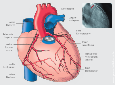 Koronare Herzkrankheit Khk Und Stabile Angina Pectoris