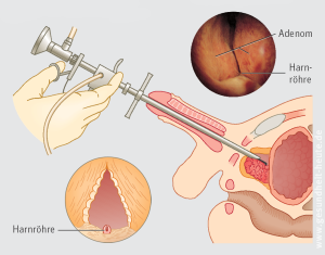 Prostatavergrosserung Gutartige