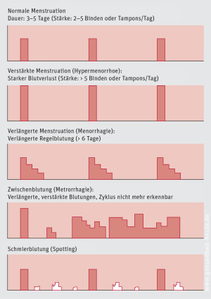 Zyklusstorungen Und Monatsblutungsstorungen