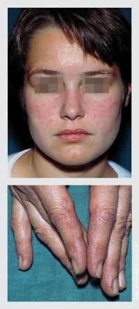 Systemischer Lupus Erythematodes