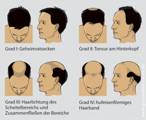 Haarausfall, androgener und diffuser